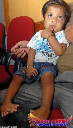 手指脚趾?4根“章鱼”男